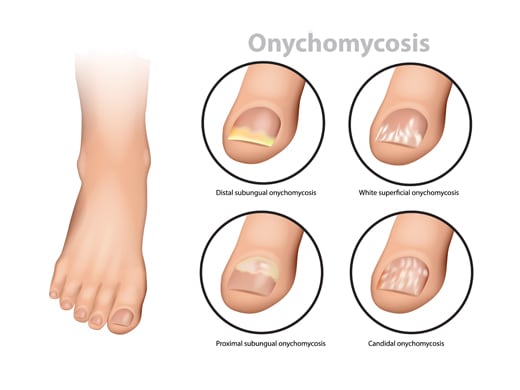 Onychomycosis | Canesten