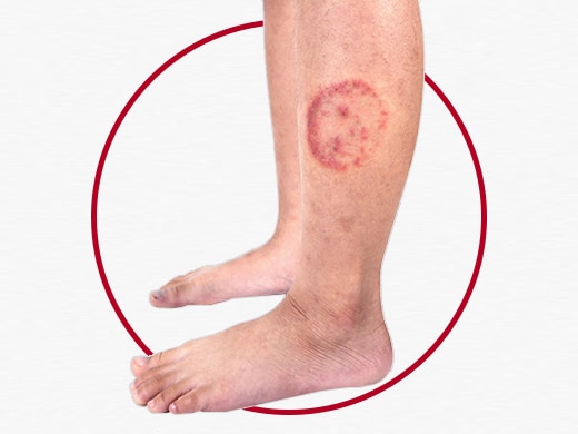 Dermatofita Penyebab, Gejala dan Pengobatannya | Canesten