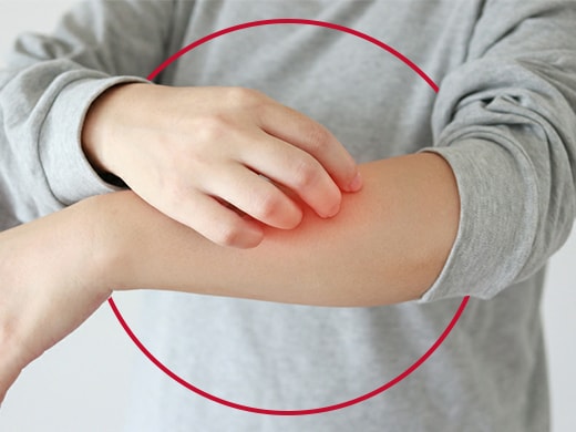 Dermatofita Penyebab, Gejala dan Pengobatannya | Canesten